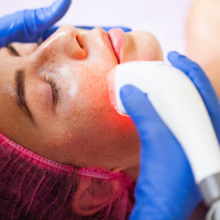 Copy of acne and acne scar treatment (4)